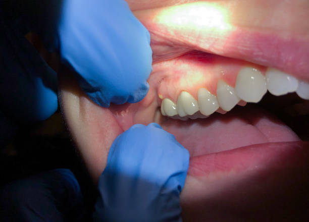 Best Emergency Dental Extractions in Pulaski, TN